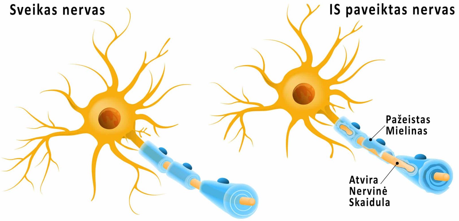 Išsėtinė sklerozė