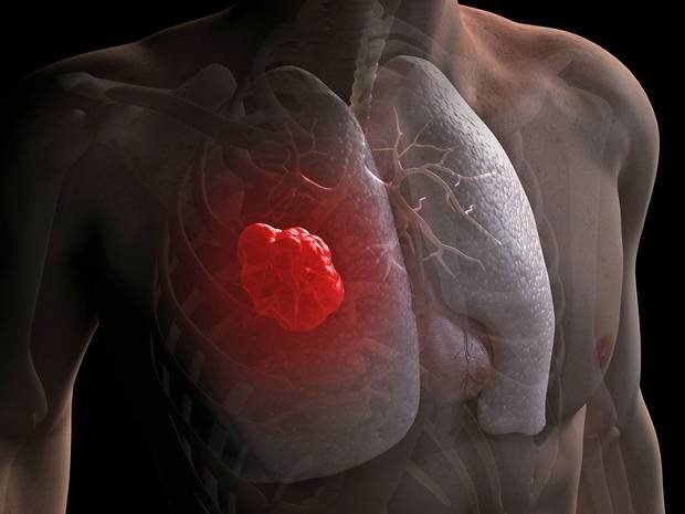 kaip mirstama nuo plauciu vezio