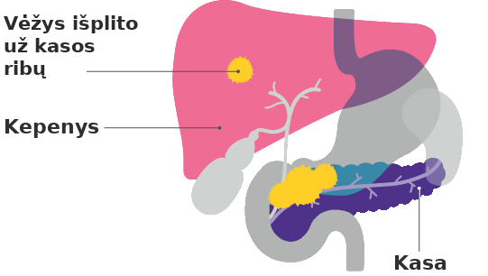 Kasos vėžys 4 stadija